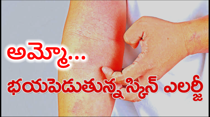 Skin Allergy Tips Telugu - ఈ సలహాలు పాటిస్తే చాలు ఎలాంటి ఎలర్జీ ఐన తగ్గుతుంది.