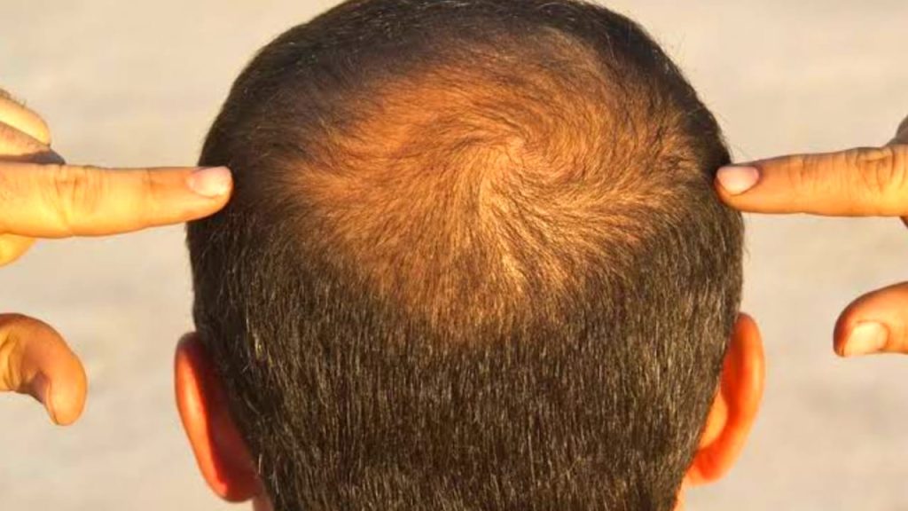 Baldness Symptoms