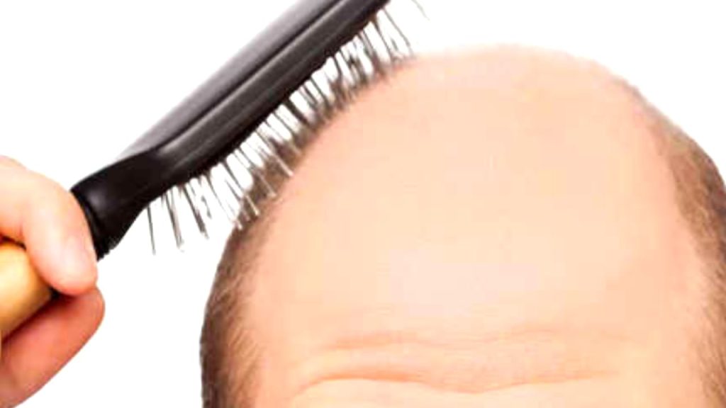 Baldness Symptoms