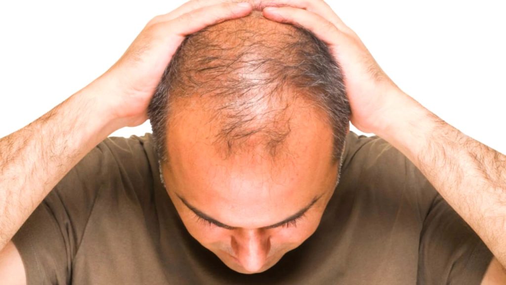 Baldness Symptoms