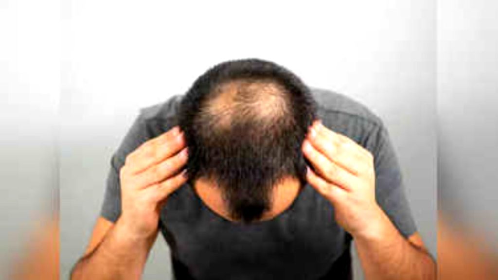 Baldness Symptoms